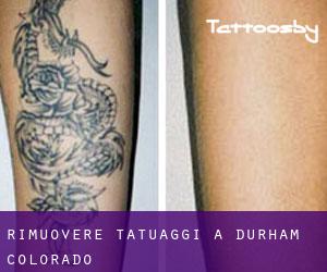 Rimuovere Tatuaggi a Durham (Colorado)