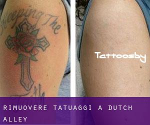Rimuovere Tatuaggi a Dutch Alley