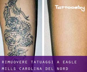 Rimuovere Tatuaggi a Eagle Mills (Carolina del Nord)