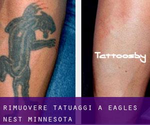 Rimuovere Tatuaggi a Eagles Nest (Minnesota)