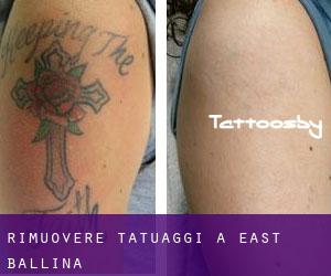 Rimuovere Tatuaggi a East Ballina