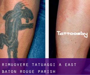 Rimuovere Tatuaggi a East Baton Rouge Parish