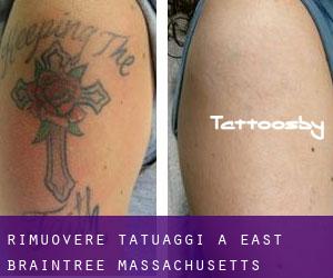 Rimuovere Tatuaggi a East Braintree (Massachusetts)