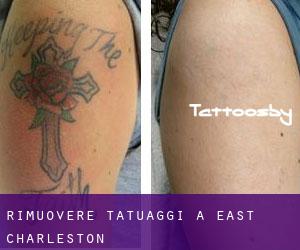 Rimuovere Tatuaggi a East Charleston