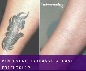 Rimuovere Tatuaggi a East Friendship