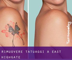Rimuovere Tatuaggi a East Highgate