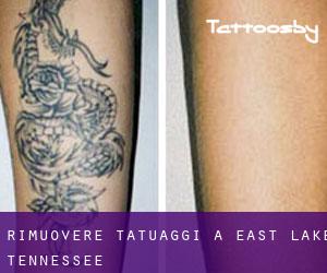 Rimuovere Tatuaggi a East Lake (Tennessee)