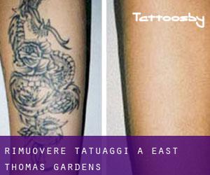 Rimuovere Tatuaggi a East Thomas Gardens