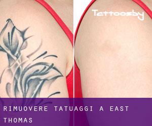 Rimuovere Tatuaggi a East Thomas