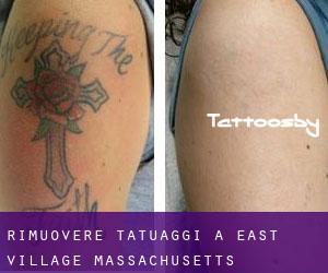 Rimuovere Tatuaggi a East Village (Massachusetts)