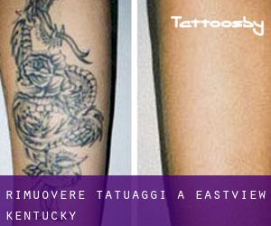 Rimuovere Tatuaggi a Eastview (Kentucky)