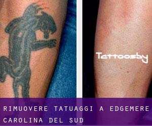 Rimuovere Tatuaggi a Edgemere (Carolina del Sud)