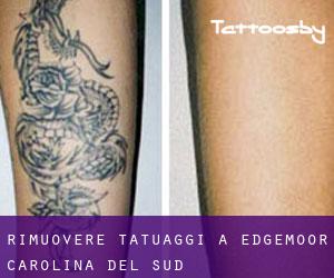 Rimuovere Tatuaggi a Edgemoor (Carolina del Sud)