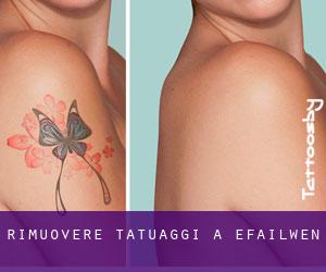 Rimuovere Tatuaggi a Efailwen