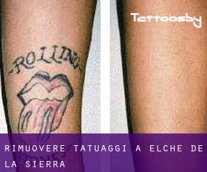 Rimuovere Tatuaggi a Elche de la Sierra