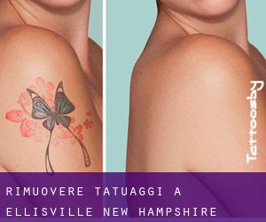 Rimuovere Tatuaggi a Ellisville (New Hampshire)