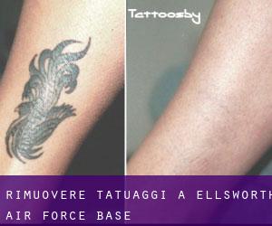 Rimuovere Tatuaggi a Ellsworth Air Force Base