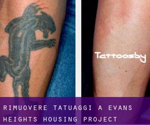 Rimuovere Tatuaggi a Evans Heights Housing Project