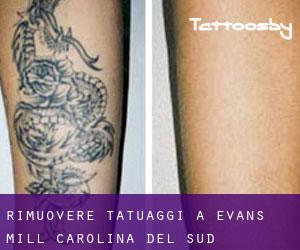 Rimuovere Tatuaggi a Evans Mill (Carolina del Sud)