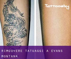 Rimuovere Tatuaggi a Evans (Montana)