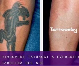 Rimuovere Tatuaggi a Evergreen (Carolina del Sud)