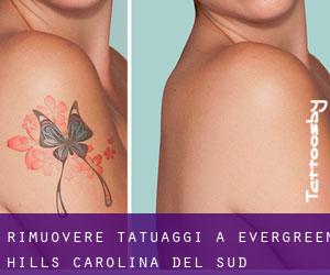 Rimuovere Tatuaggi a Evergreen Hills (Carolina del Sud)
