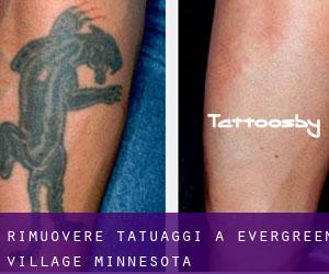 Rimuovere Tatuaggi a Evergreen Village (Minnesota)