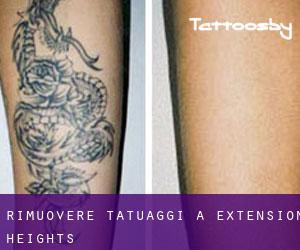 Rimuovere Tatuaggi a Extension Heights
