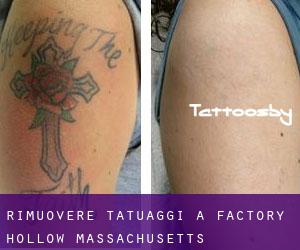 Rimuovere Tatuaggi a Factory Hollow (Massachusetts)