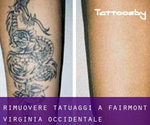 Rimuovere Tatuaggi a Fairmont (Virginia Occidentale)
