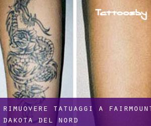 Rimuovere Tatuaggi a Fairmount (Dakota del Nord)