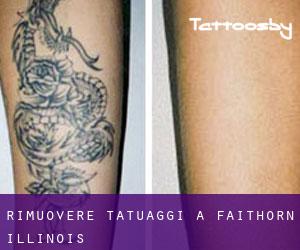 Rimuovere Tatuaggi a Faithorn (Illinois)