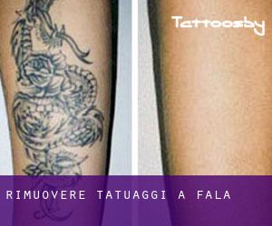 Rimuovere Tatuaggi a Fala