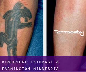 Rimuovere Tatuaggi a Farmington (Minnesota)