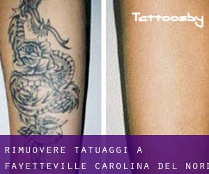 Rimuovere Tatuaggi a Fayetteville (Carolina del Nord)