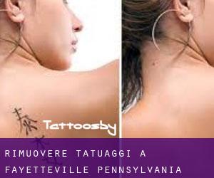Rimuovere Tatuaggi a Fayetteville (Pennsylvania)