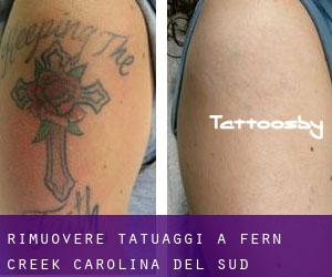Rimuovere Tatuaggi a Fern Creek (Carolina del Sud)