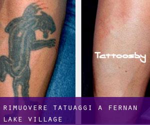 Rimuovere Tatuaggi a Fernan Lake Village