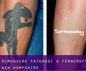 Rimuovere Tatuaggi a Ferncroft (New Hampshire)