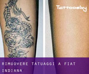 Rimuovere Tatuaggi a Fiat (Indiana)
