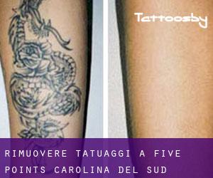 Rimuovere Tatuaggi a Five Points (Carolina del Sud)