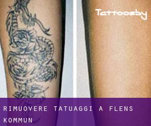 Rimuovere Tatuaggi a Flens Kommun