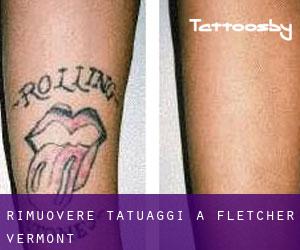 Rimuovere Tatuaggi a Fletcher (Vermont)