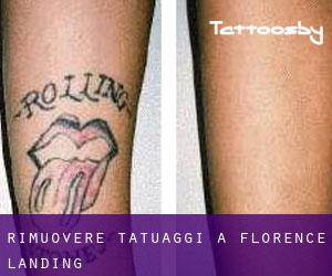 Rimuovere Tatuaggi a Florence Landing
