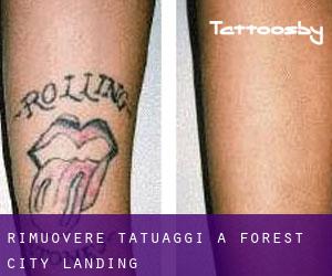 Rimuovere Tatuaggi a Forest City Landing