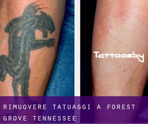 Rimuovere Tatuaggi a Forest Grove (Tennessee)