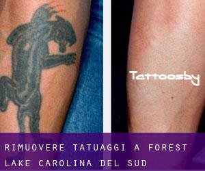 Rimuovere Tatuaggi a Forest Lake (Carolina del Sud)