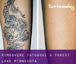 Rimuovere Tatuaggi a Forest Lake (Minnesota)