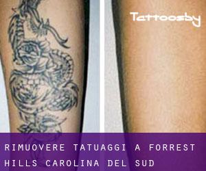Rimuovere Tatuaggi a Forrest Hills (Carolina del Sud)