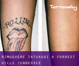 Rimuovere Tatuaggi a Forrest Hills (Tennessee)